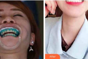 江陰金誠口腔門診部張杰整形價格表附冷光美白案例展示