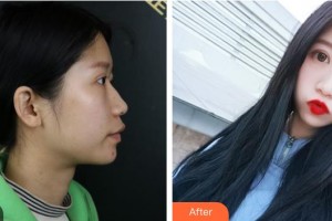 江陰光明眼科醫(yī)院汪曉倩整形價格表附切開雙眼皮案例展示