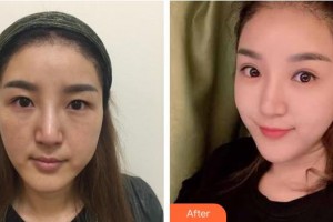 江陰光明眼科醫(yī)院劉華整形價格表附眼部修復案例展示