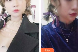 江陰光明眼科醫(yī)院陳義兵整形價格表附切開雙眼皮案例展示