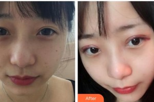 江陰光明眼科醫(yī)院石丹整形價格表附切開雙眼皮案例展示