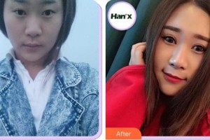 江陰光明眼科醫(yī)院鄒俊整形價格表附切開雙眼皮案例展示