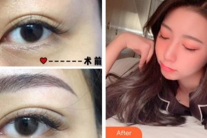 海南瑞韓醫(yī)學(xué)美容醫(yī)院徐春梅整形價(jià)格表附埋線雙眼皮案例展示