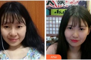 海南眼科醫(yī)院陳海波整形價(jià)格表附切開雙眼皮案例展示