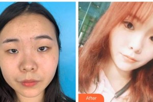 海南眼科醫(yī)院張秀妮整形價(jià)格表附定點(diǎn)雙眼皮案例展示