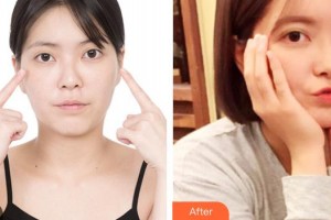 海南眼科醫(yī)院龍登虹整形價(jià)格表附開內(nèi)眼角案例展示