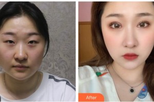 海南眼科醫(yī)院楊軍整形價(jià)格表附眼部綜合案例展示