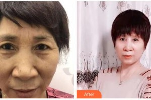 海南眼科醫(yī)院曾明兵整形價(jià)格表附切眉術(shù)案例展示