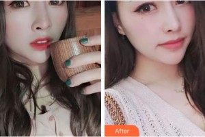 海南眼科醫(yī)院郭惠宇整形價(jià)格表附眼部綜合案例展示