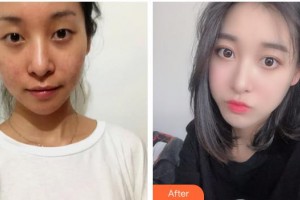 海南眼視光學(xué)中心門診部李加青整形價(jià)格表附開內(nèi)眼角案例展示