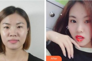 海南眼視光學(xué)中心門診部劉春民整形價(jià)格表附切開雙眼皮案例展示