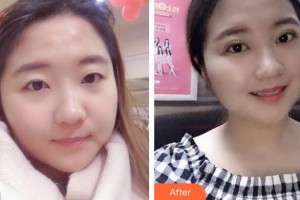 海南省中醫(yī)院眼科中心任韓整形價(jià)格表附切開雙眼皮案例展示