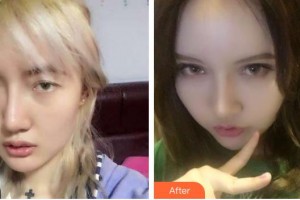 海南省中醫(yī)院眼科中心廖繼波整形價(jià)格表附切開雙眼皮案例展示