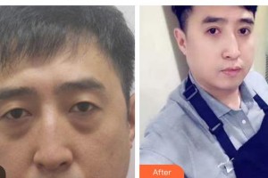 海南省中醫(yī)院眼科中心陳得謎住院醫(yī)師整形價(jià)格表附切開雙眼皮案例展示