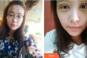 海南省中醫(yī)院眼科中心郭翠玲整形價(jià)格表附切開雙眼皮案例展示