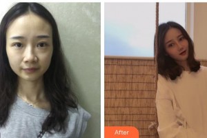 海南眼視光學(xué)中心門診部梁瓊整形價(jià)格表附切開雙眼皮案例展示