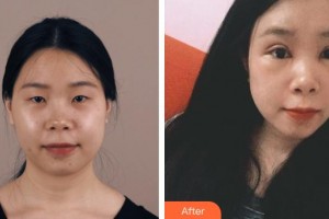 海南眼科醫(yī)院劉紅山整形價(jià)格表附眼部綜合案例展示