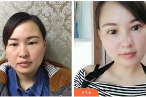 海南眼科醫(yī)院史貽玉整形價(jià)格表附切開雙眼皮案例展示