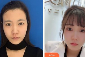 海口東湖醫(yī)學(xué)美容整形醫(yī)院張文其整形價格表附去痘印痘坑案例展示