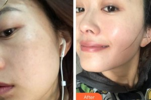 ?？邬i愛醫(yī)療美容醫(yī)院任秀麗整形價格表附激光祛斑案例展示