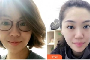 海口崔曦文醫(yī)療美容診所崔曦文整形價格表附光子嫩膚案例展示