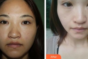 ?？谑械谒娜嗣襻t(yī)院眼科鐘羽麗整形價格表附清潔祛痘案例展示