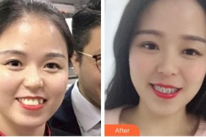 ?？诤佳谰S信口腔門診部李娜住院醫(yī)師整形價格表附自鎖托槽矯正案例展示