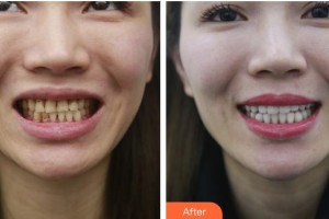 海口杭牙維信口腔門診部吳惠強整形價格表附美白貼片案例展示