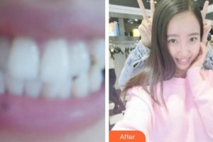 ?？诤佳谰S信口腔門診部楊惦山整形價格表附牙齒隱形矯正案例展示