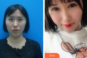 海口紅妝尚醫(yī)療美容門診部羅勇整形價格表附內(nèi)切祛眼袋案例展示