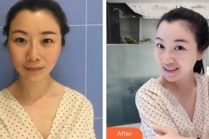 ?？诩t妝尚醫(yī)療美容門診部李楠整形價格表附埋線提升案例展示