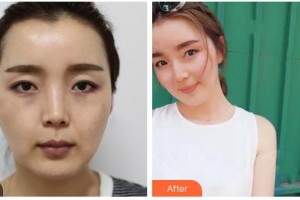 海口紅妝尚醫(yī)療美容門診部郭理霖整形價格表附熱拉提案例展示