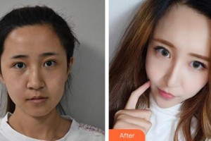 揚州施爾美醫(yī)療美容醫(yī)院楊蘇整形價格表附激光祛斑案例展示