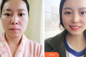 揚(yáng)州施爾美醫(yī)療美容醫(yī)院厲建華整形價(jià)格表附激光祛斑案例展示