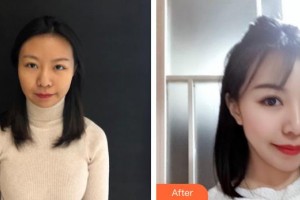 揚州第一人民醫(yī)院整形美容科馮有支整形價格表附去痘印痘坑案例展示