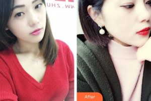 揚(yáng)州第一人民醫(yī)院整形美容科陳菊萍整形價(jià)格表附無(wú)針?biāo)獍咐故?>
</a>
<h3 class=