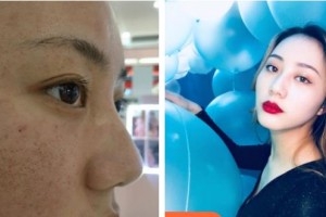 揚州施爾美醫(yī)療美容醫(yī)院王釗整形價格表附去痘印痘坑案例展示