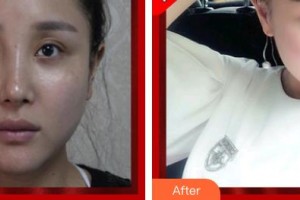 揚州第一人民醫(yī)院整形美容科夏卉整形價格表附清潔祛痘案例展示