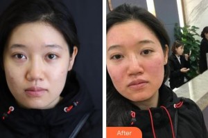 揚州施爾美醫(yī)療美容醫(yī)院代淑媛整形價格表附祛斑祛痣案例展示