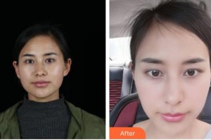 揚州市中醫(yī)院醫(yī)學美容中心蘇培增整形價格表附激光祛斑案例展示