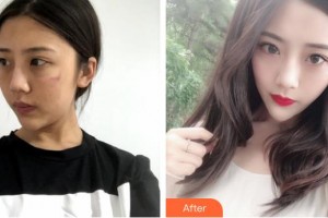 揚州施爾美醫(yī)療美容醫(yī)院趙金花整形價格表附白瓷娃娃案例展示