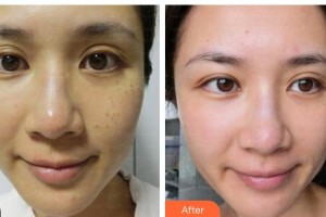 揚州麗致醫(yī)療美容門診部翟躍中整形價格表附祛妊娠紋案例展示