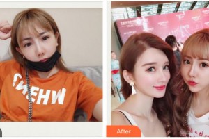 揚州麗致醫(yī)療美容門診部付林杰整形價格表附水氧活膚案例展示