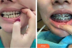 揚州艾菲斯醫(yī)療美容門診部韋新東整形價格表附牙齒隱形矯正案例展示