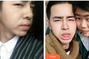 揚州艾菲斯醫(yī)療美容門診部羅田田整形價格表附金屬托槽矯正案例展示