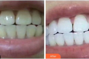 揚州艾菲斯醫(yī)療美容門診部王愛梅整形價格表附美白貼片案例展示