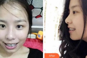 揚(yáng)州貝恩口腔醫(yī)院曾小法整形價(jià)格表附金屬托槽矯正案例展示