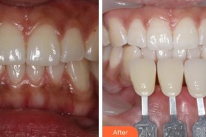 揚(yáng)州黃嬋醫(yī)療美容診所黃嬋整形價(jià)格表附冷光美白案例展示