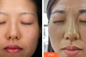 荊州迪亞羅蘭醫(yī)療美容門診部羅蘭整形價格表附光子嫩膚案例展示