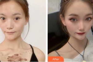 荊州市第二人民醫(yī)院整形激光美容中心林海濤整形價格表附微創(chuàng)疤痕修復(fù)案例展示